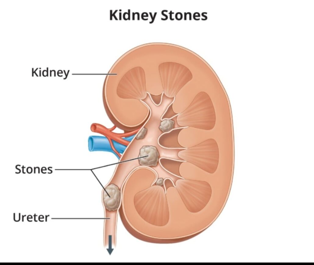 Kidney Stone Fast Pain Relief | WAI Acupuncture